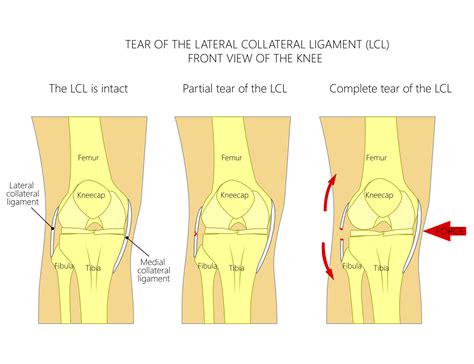 lcl tear symptoms in knee